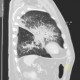 Bronchopneumonia, biopsy: CT - Computed tomography